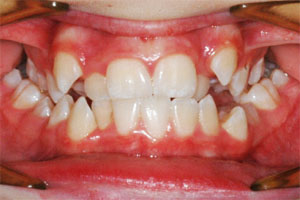 بهم ریختگی شدید دندانها  در کودکان قبل از ارتودنسی