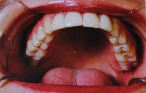سفیدی دندان بعد از لامینت
