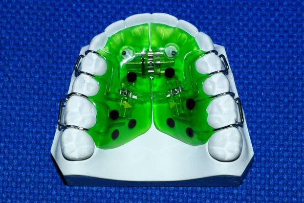 Аппарат хасса. Аппарат пендулум "лягушка"ортодонтия. Пластина для выпрямления зубов. Пластина для выпрямления зубов детям. Аппарат для выпрямления зубов.